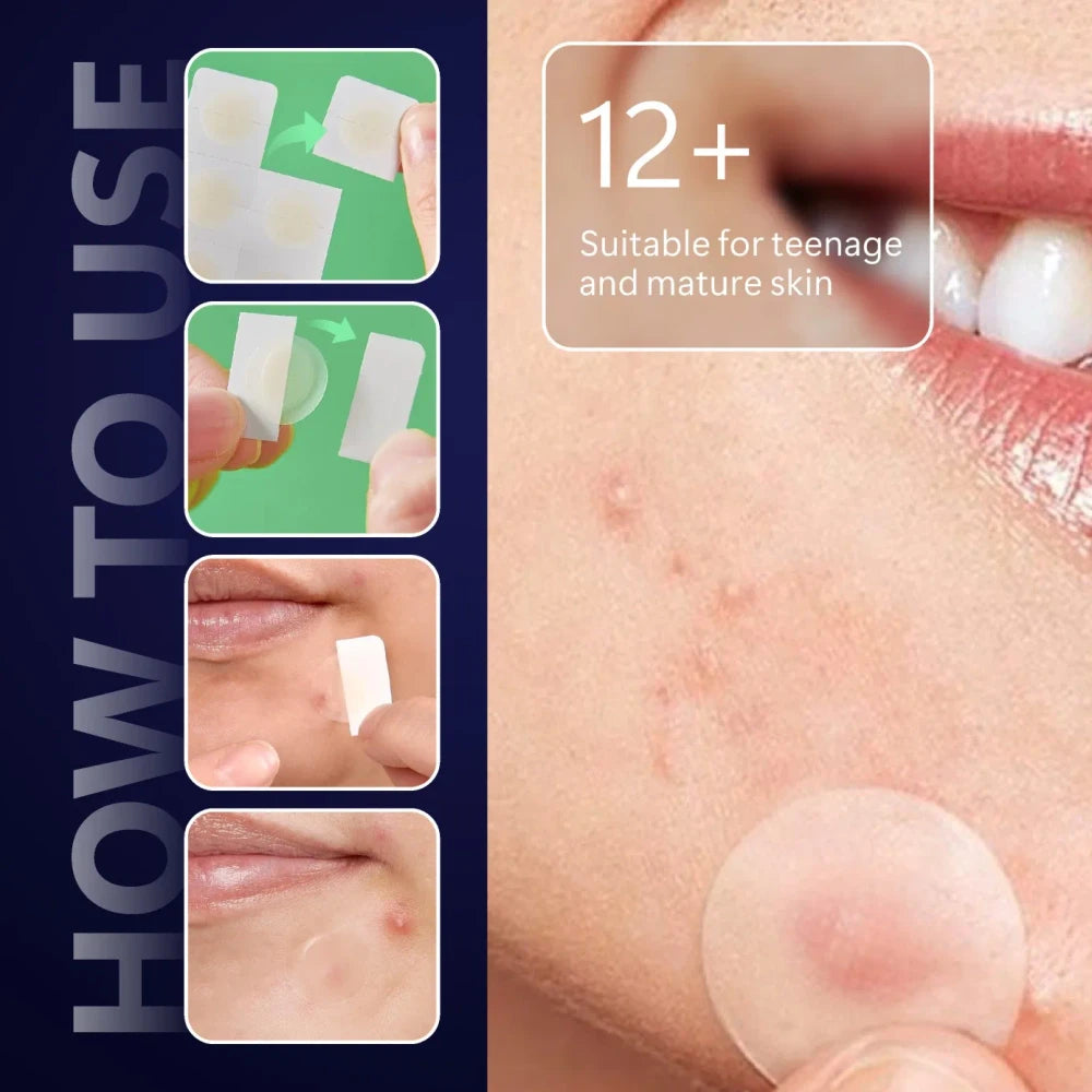 Overnight Micro-Dart Acne Patches